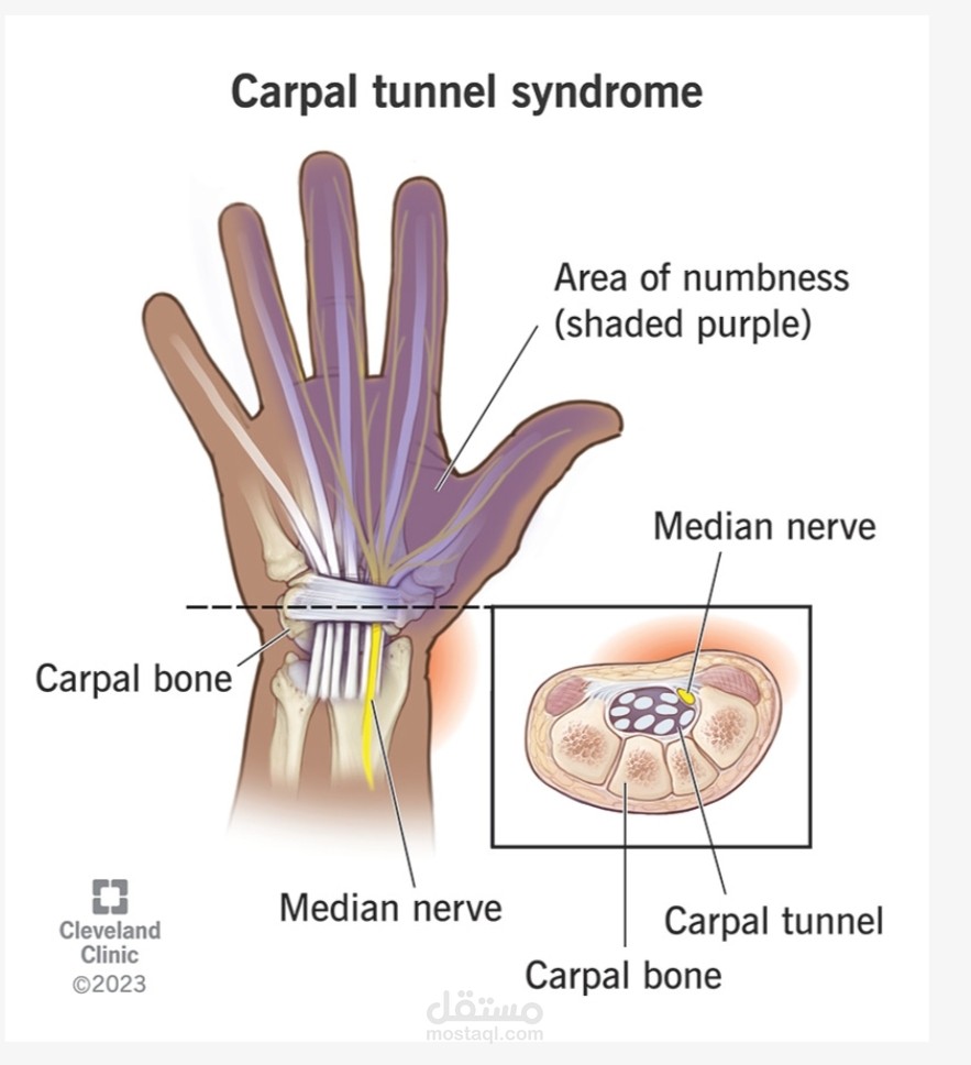 carpal tunnel syndrome