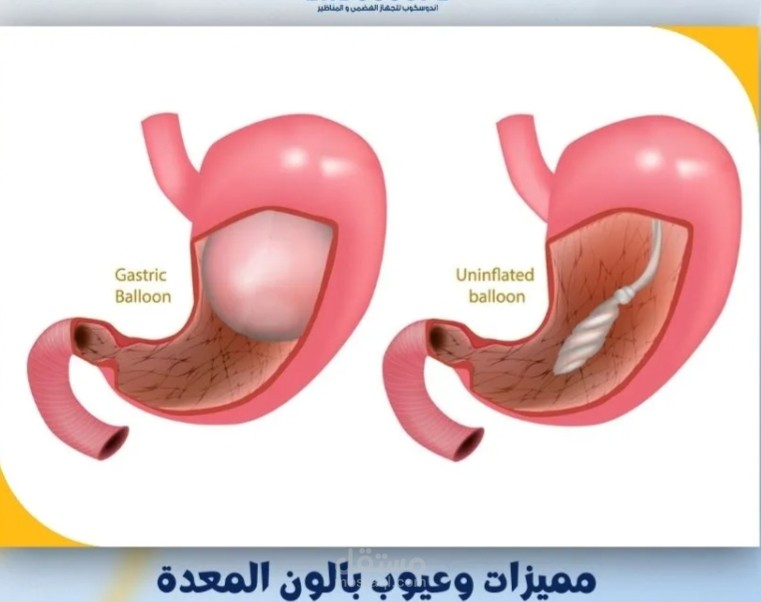 مقال طبي بعنوان "تجربتي مع بالون المعدة"