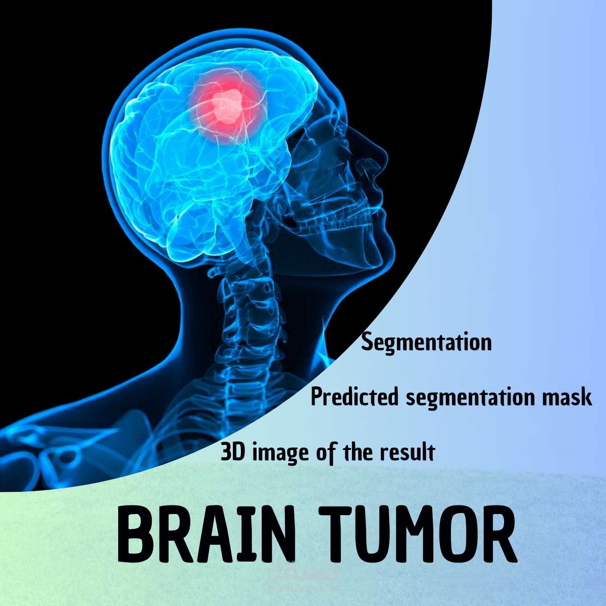 Brain Tumor Segmentation using SwinUNETR Model