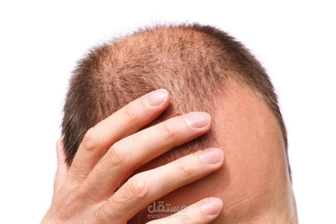 تساقط الشعر