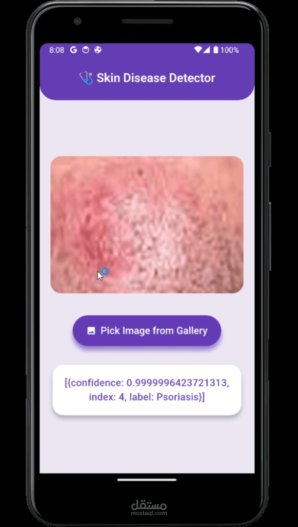 تطبيق ذكي للتعرف على الأمراض الجلدية باستخدام الذكاء الاصطناعي