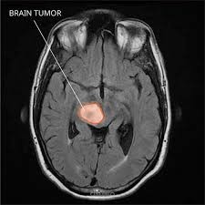 Brain Tumar Classification