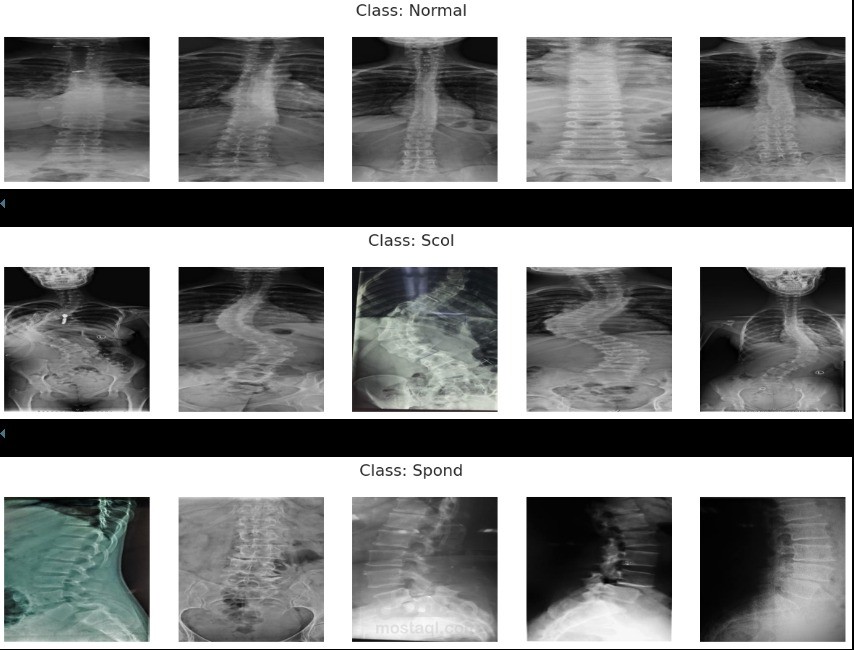 Spine X-Ray Classification Using Deep Learning