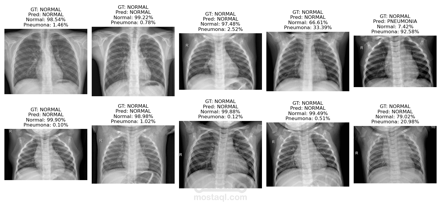 Chest X-Ray Pneumonia Detection