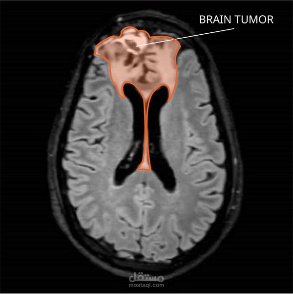 Brain tumors detection based on deep learning using CNN