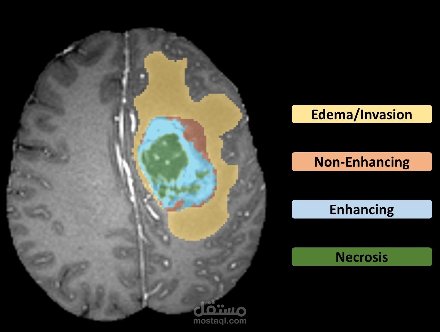 Brain Tumor Segmentation and Multimodal Medical  Image Fusion