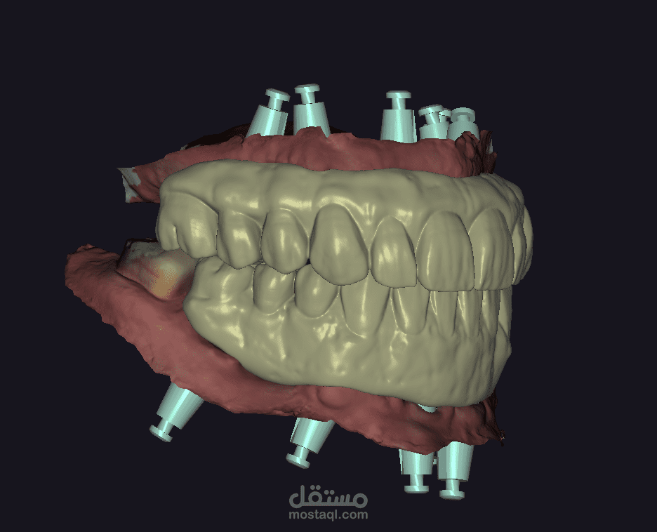 تصميم لتركيب كامل على زرعات اسنان للفكين