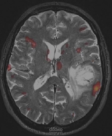 Brain_Tumor_classification