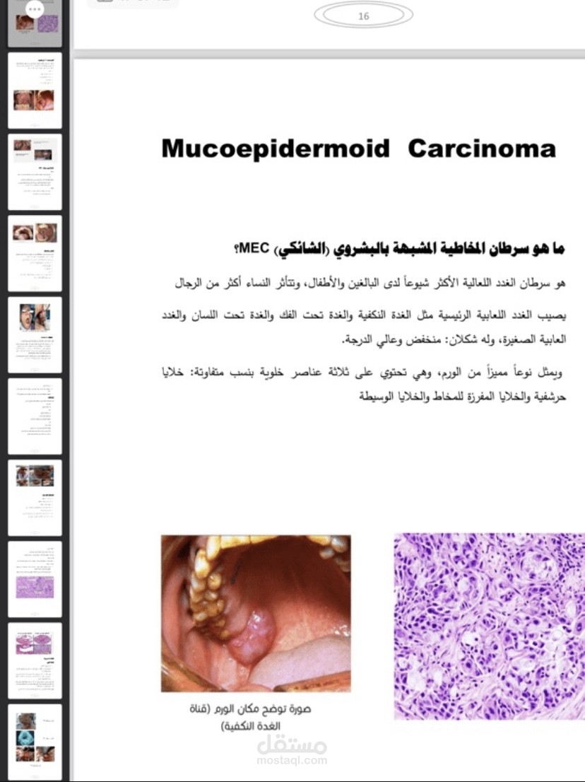 اورام العقد اللمفاوية مع صور سريرية