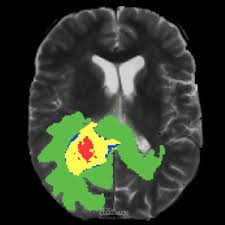 Brain Tumor Segmentation