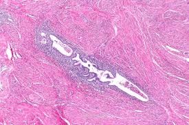 Adenomyosis associated infertility