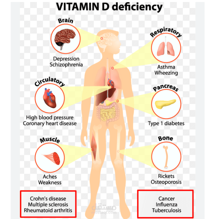 تلخيص مقال طبي وترجمته عن                             Vitamin d deficiency