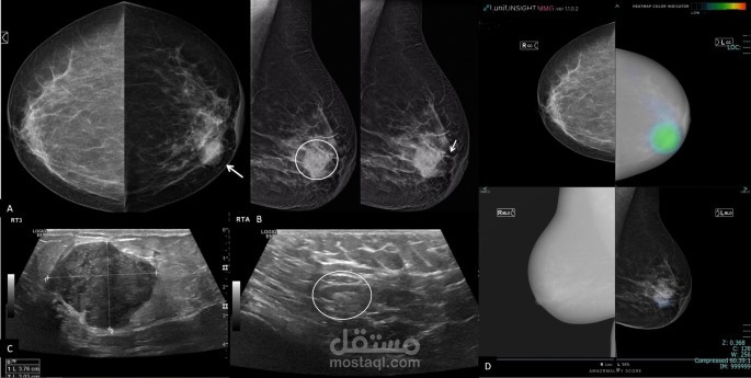(classification by computer vision)Breast Cancer