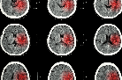 تصنيف السكتات الدماغية باستخدام التعلم العميق (Brain Stroke Classification Using Deep Learning)