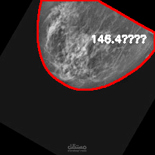 بروجيكت اكتشاف السرطان