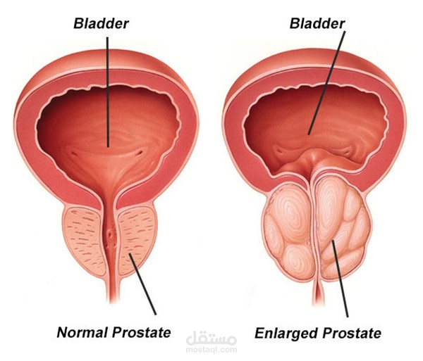 Benign prostatic hyperplasia