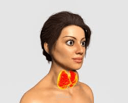 Graves Disease (PowerPoint)