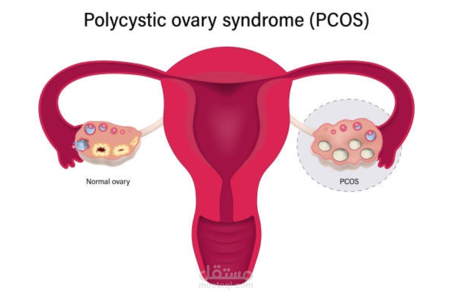 تكيسات المبايض: أسبابها، أعراضها، وما علاقة تكيسات المبايض بتأخر الحمل؟