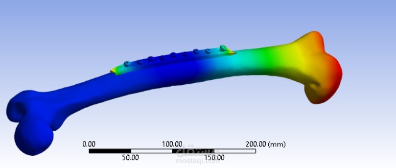تصميم ومحاكاة عظمة الفخذ باستخدام صفيحة من سبيكة ZK60 باستخدام برنامج ANSYS