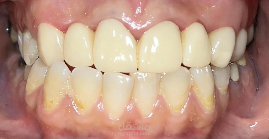 Veneers | Dental Motion
