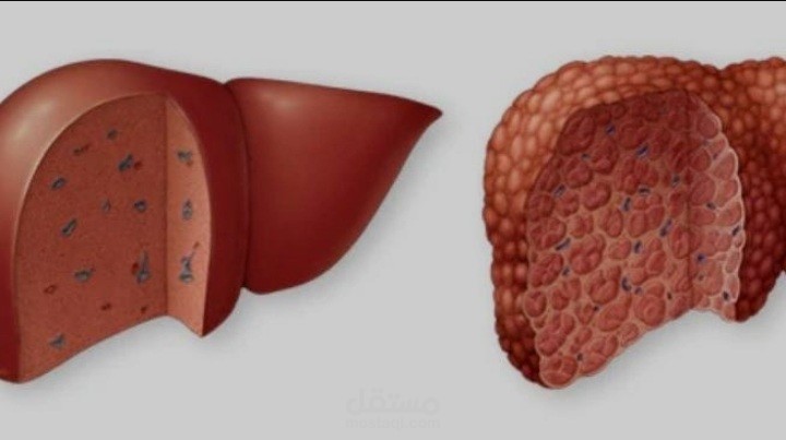 Liver cirrhosis تليف الكبد