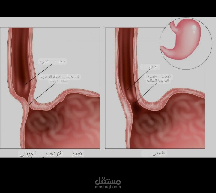 Achalasia