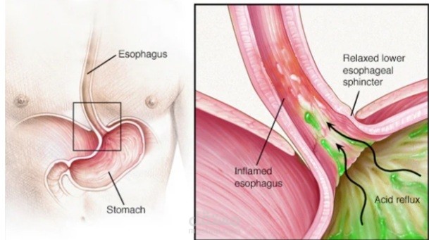 Gastroeseophageal reflux disease