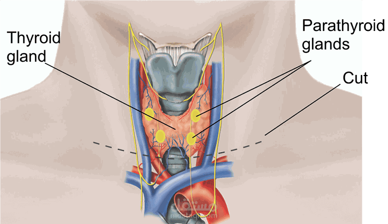 استئصال الغدد الجار درقية (Parathyroidectomy)