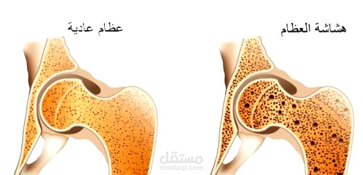 مقالة عن مرض هشاشة العظام