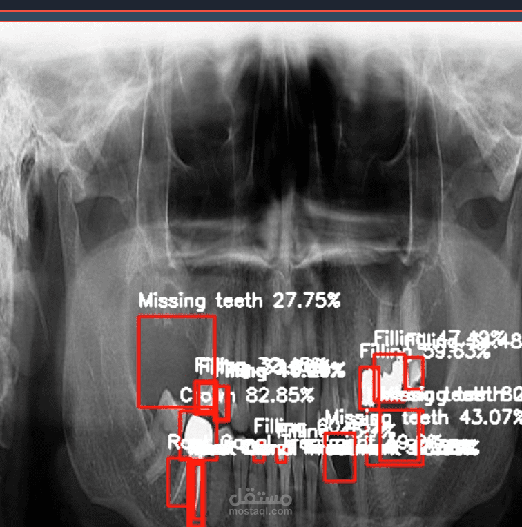 Dental Disease Detection YOLOv11. real-time panoramic dental disease detection system