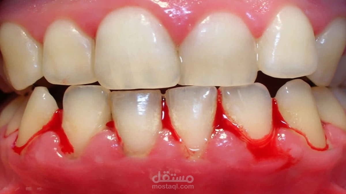 التهاب ونزيف اللثة