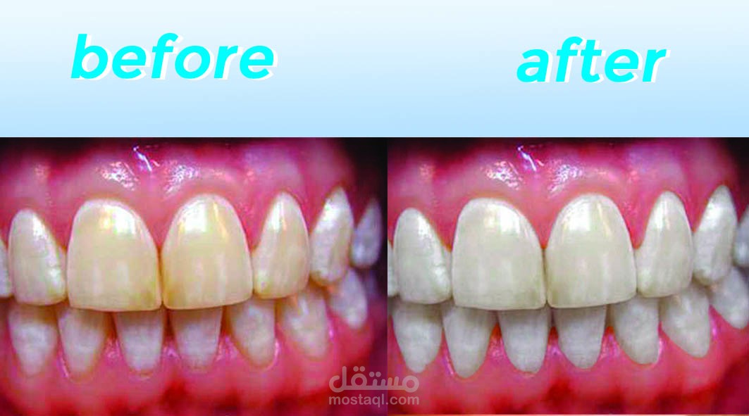 تبيض الأسنان