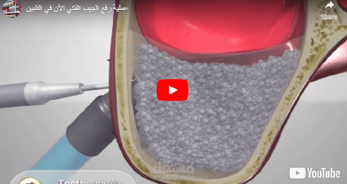 ترجمة فيديو توضيحي لعملية جراحية