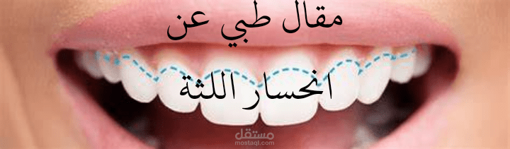 مقال بعنوان "انحسار اللثة"
