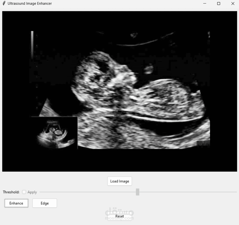 Ultrasound Picture Enhancer