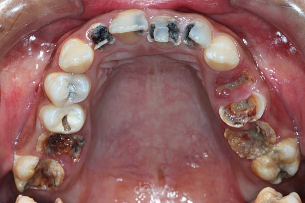 Oral Diseases Classification