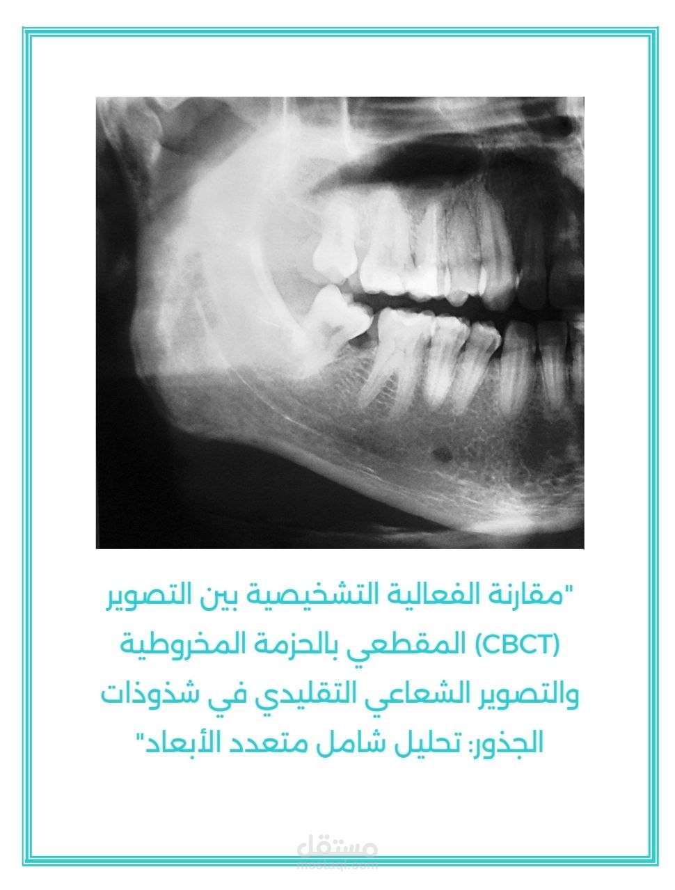 مقارنة الفعالية التشخيصية بين التصوير المقطعي بالحزمة المخروطية (CBCT) و التصوير الشعاعي التقليدي في شذوذات الجذور: تحليل شامل متعدد الأبعاد