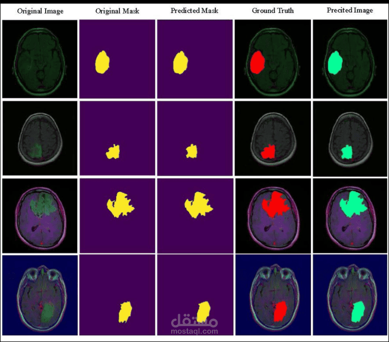 تصنيف أورام الدماغ وتقسيمها من صور MRI