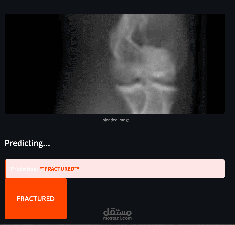 Bone Fracture Detection using Computer Vision