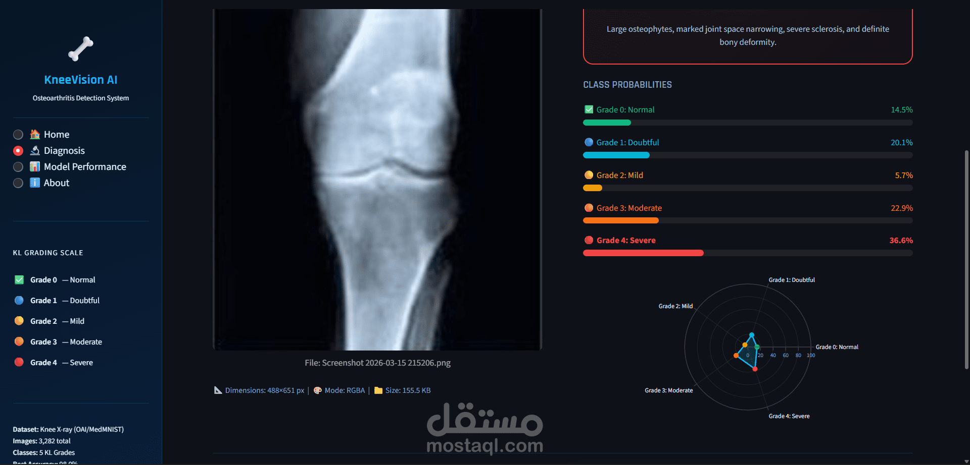KneeVision: حل تقني يعتمد على EfficientNet لتصنيف خشونة الركبة بدقة 98%