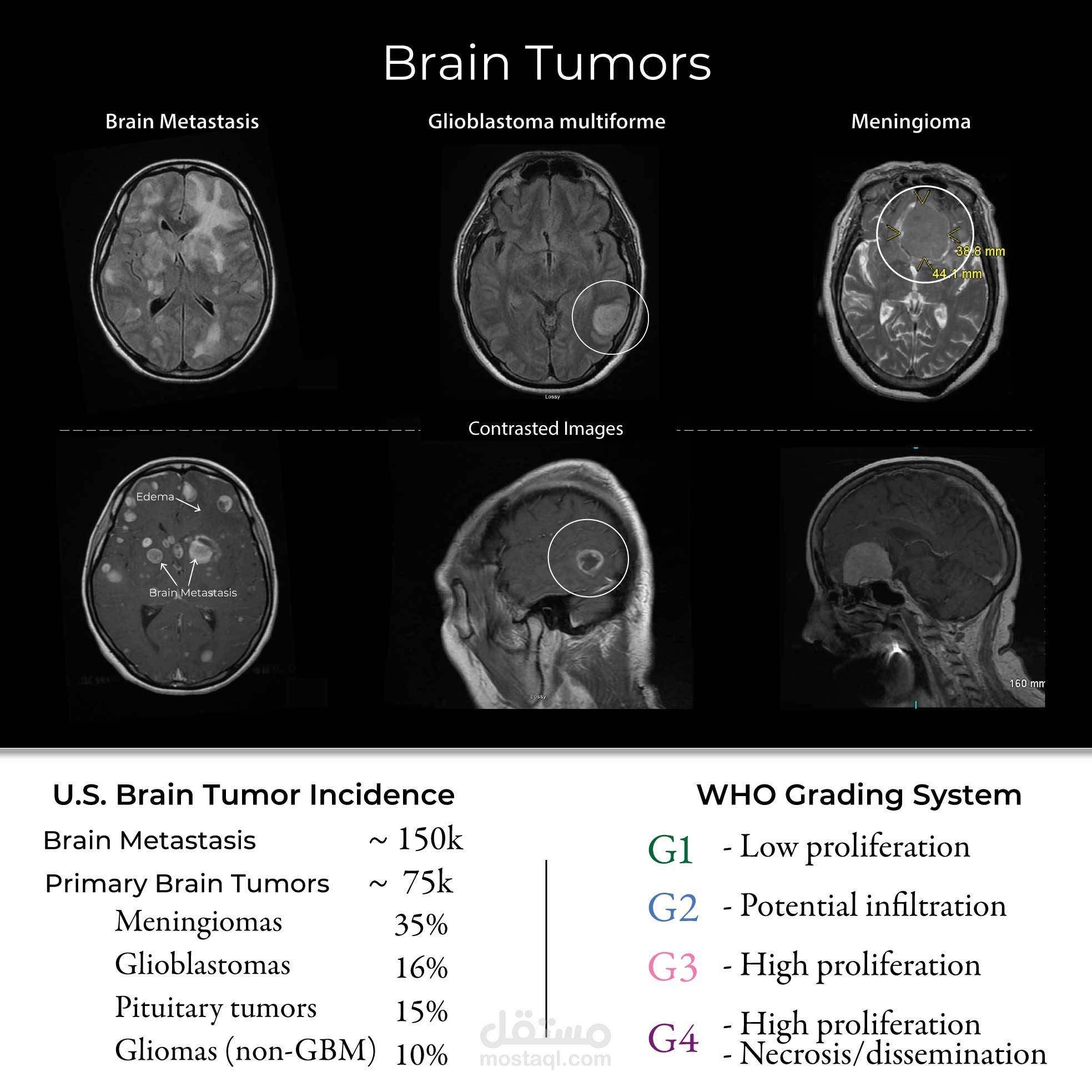 Brain Tumor Classification