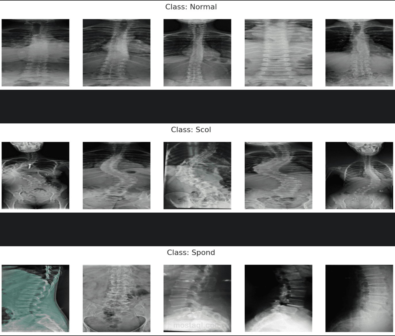 Spine X-ray classification using deep learning