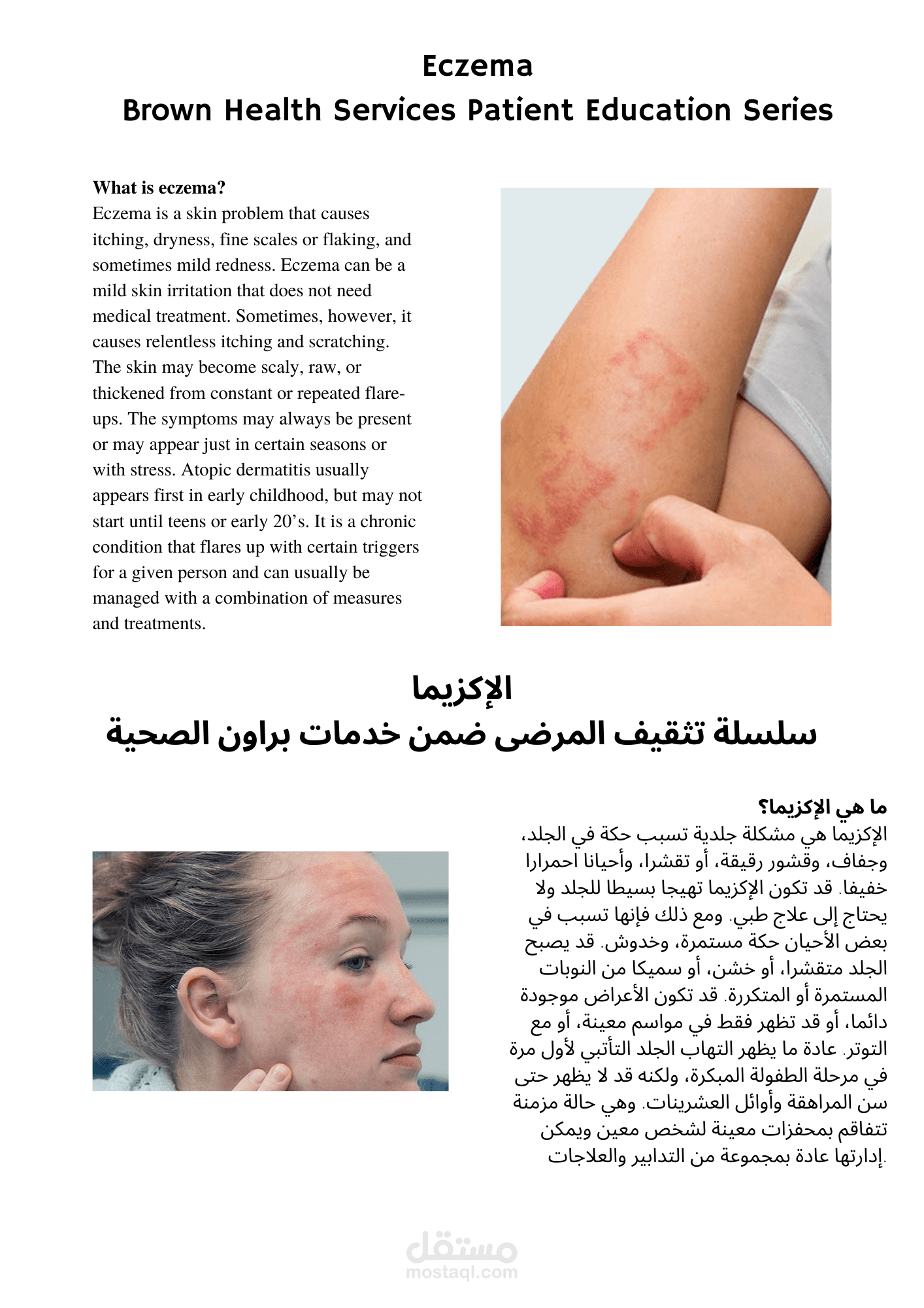 ترجمة نص طبي عن الإكزيما