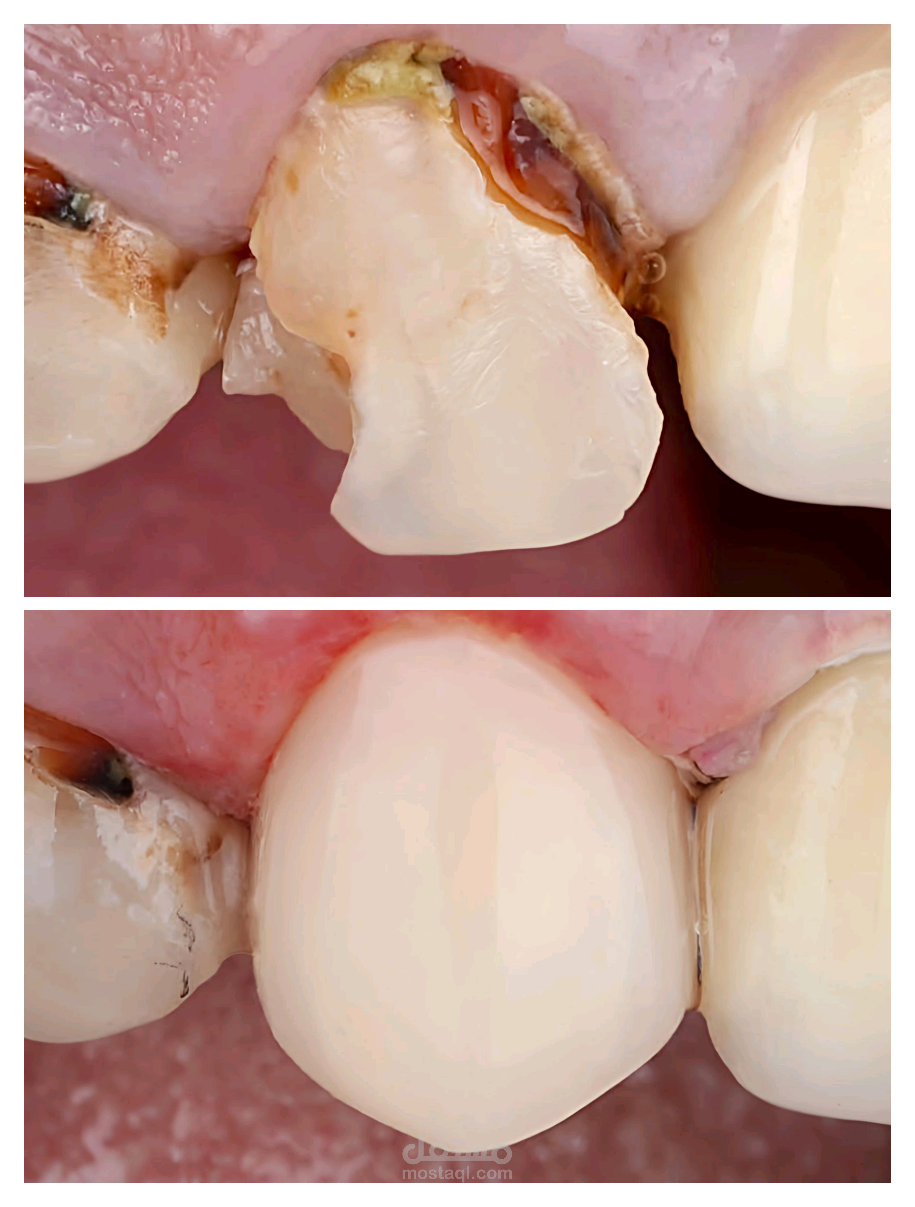 Anterior Resin Crown