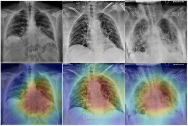 ?  Pneumonia Detection from X-rays