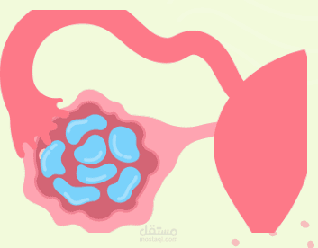 PCOS Detection Using  Machine Learning and Deep  Learning: Web and Mobile
