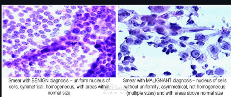 تصنيف أنواع السرطان من بيانات جينية
