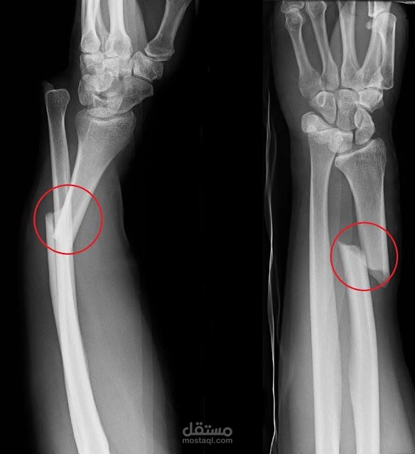 Bone Fracture Detection