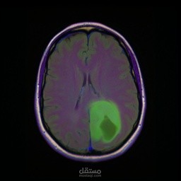 Brain-tumor-ai-detection