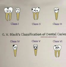 التفريق بين النخور السنيه في طب الأسنان